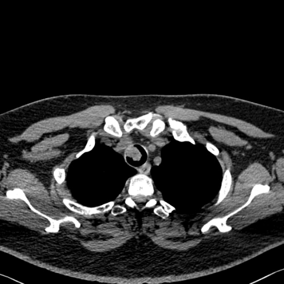 Adenoid cystic carcinoma of the trachea (Radiopaedia 49042-54137 Axial non-contrast 51).jpg