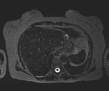 File:Adenomyomatosis of the gallbladder (Radiopaedia 50246-55587 Axial 113).png