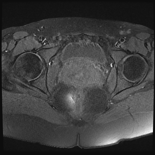 File:Adenomyosis-scar endometriosis (Radiopaedia 65863-75022 Axial T1 fat sat 21).jpg