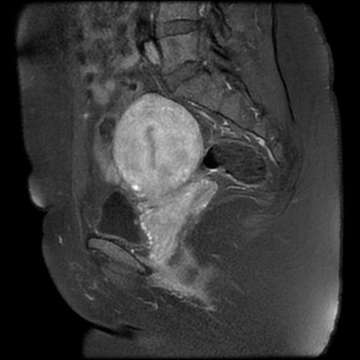 File:Adenomyosis-scar endometriosis (Radiopaedia 65863-75022 Sagittal T1 C+ fat sat 16).jpg