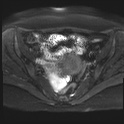 File:Adenomyosis and endometriotic cysts (Radiopaedia 82300-96367 Axial DWI 13).jpg