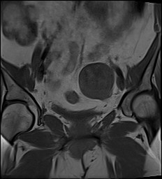 File:Adnexal multilocular cyst (O-RADS US 3- O-RADS MRI 3) (Radiopaedia 87426-103754 Coronal 14).jpg