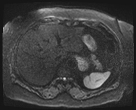 Adrenal cortical carcinoma (Radiopaedia 64017-72770 Axial DWI 49).jpg