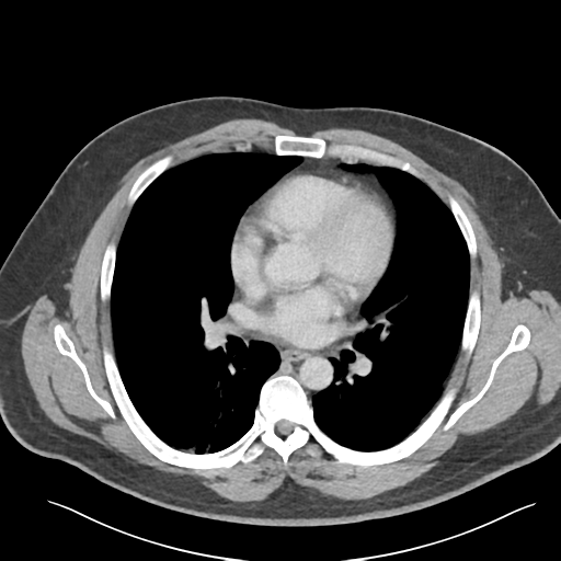 Adrenal cyst (Radiopaedia 45625-49777 Axial C+ portal venous phase 1).png