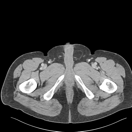 Adrenal cyst (Radiopaedia 45625-49777 Axial C+ portal venous phase 109).png