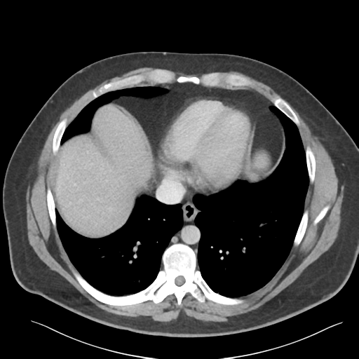 File:Adrenal cyst (Radiopaedia 45625-49777 Axial C+ portal venous phase 13).png