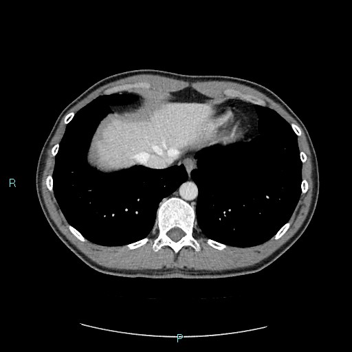 Adrenal cystic lymphangioma (Radiopaedia 83161-97534 Axial C+ portal venous phase 12).jpg