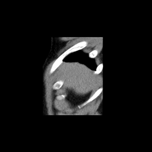 Adrenal gland trauma (Radiopaedia 81351-95079 Sagittal non-contrast 6).jpg