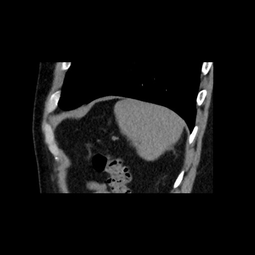 File:Adrenal gland trauma (Radiopaedia 81351-95079 Sagittal non-contrast 86).jpg