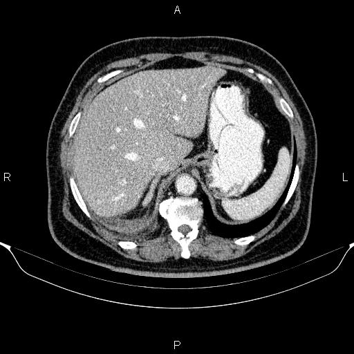 Adrenal hemorrhage (Radiopaedia 62622-70916 Axial C+ portal venous phase 31).jpg