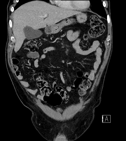 Adrenal lymphoma (Radiopaedia 73730-84529 Coronal C+ portal venous phase 23).jpg