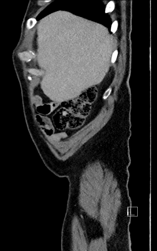 Adrenal lymphoma (Radiopaedia 73730-84529 Sagittal C+ portal venous phase 11).jpg