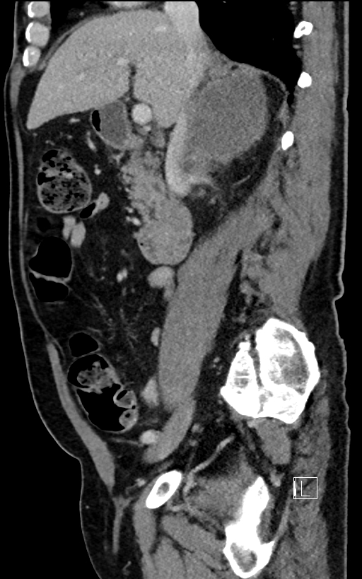 Adrenal lymphoma (Radiopaedia 73730-84529 Sagittal C+ portal venous phase 45).jpg