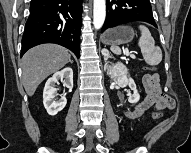 Adrenal metastases (Radiopaedia 73082-83791 Coronal C+ arterial phase 49).jpg