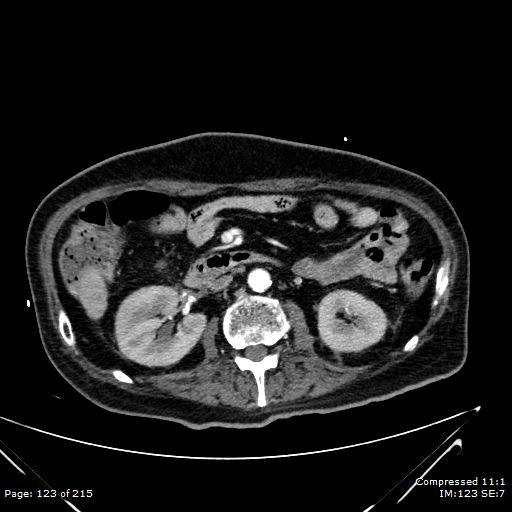 Adrenal metastasis (Radiopaedia 78425-91079 Axial C+ arterial phase 53).jpg