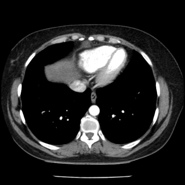 Adrenal myelolipoma (Radiopaedia 43401-46759 Axial C+ arterial phase 5).jpg