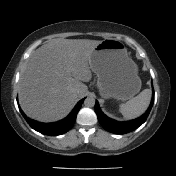 Adrenal myelolipoma (Radiopaedia 43401-46759 Axial non-contrast 17).jpg