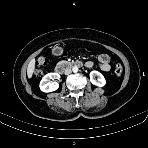 File:Adrenal myelolipoma (Radiopaedia 82742-96986 Axial renal cortical phase 85).jpg