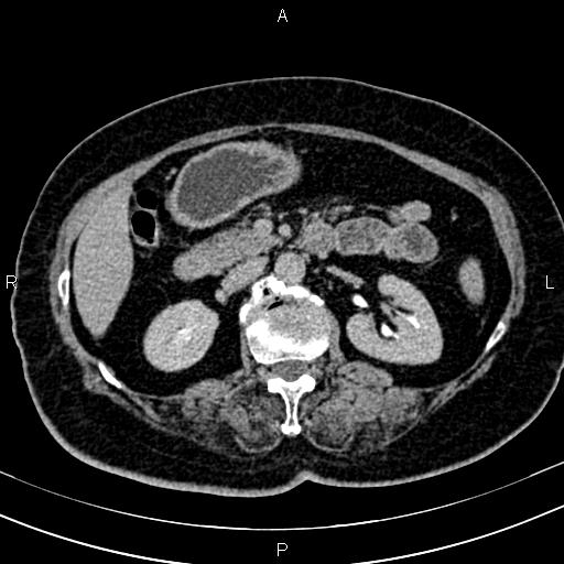 Adrenal myelolipoma (Radiopaedia 82742-96986 Axial renal excretory phase 59).jpg