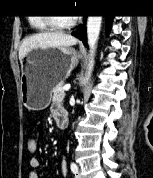 Adrenal myelolipoma (Radiopaedia 82742-96986 Sagittal renal cortical phase 63).jpg