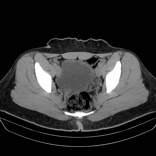 Adrenal myelolipoma - bilateral (Radiopaedia 74805-85810 Axial non-contrast 73).jpg