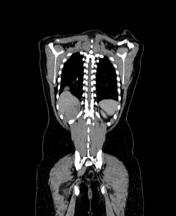Adrenocortical carcinoma (Radiopaedia 80134-93438 Coronal C+ portal venous phase 136).jpg