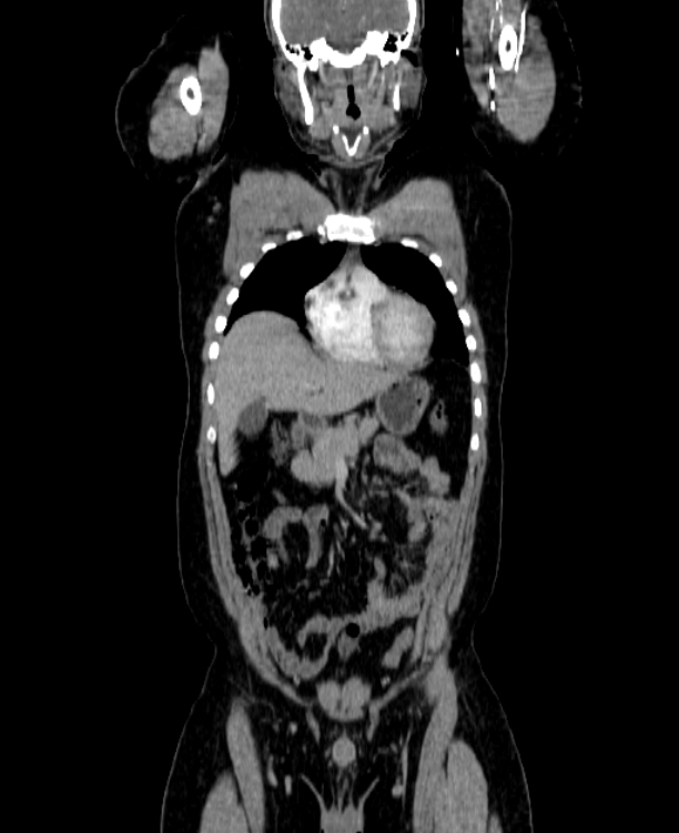Adrenocortical carcinoma (Radiopaedia 80134-93438 Coronal C+ portal venous phase 53).jpg