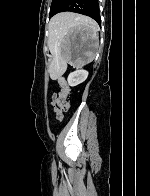 Adrenocortical carcinoma (Radiopaedia 87281-103569 Sagittal C+ portal venous phase 52).jpg