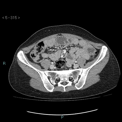 Adult transient intestinal intussusception (Radiopaedia 34853-36310 Axial C+ portal venous phase 75).jpg