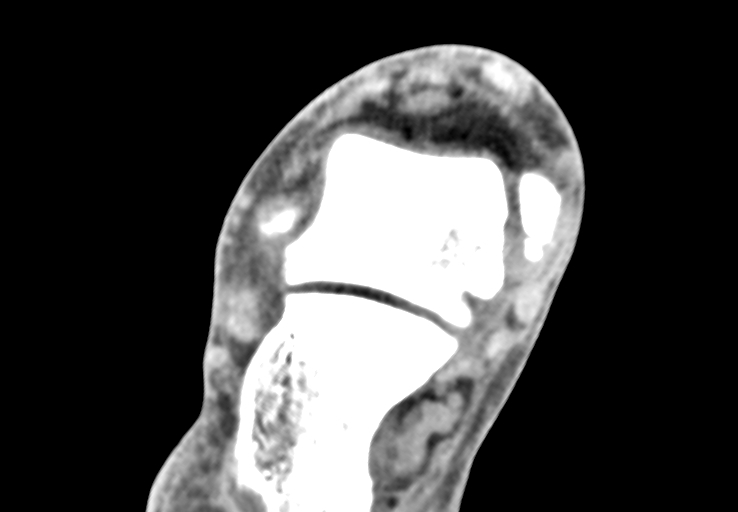 Advanced osteomyelitis due to open metatarsal fracture (Radiopaedia 83891-99095 Axial non-contrast 7).jpg