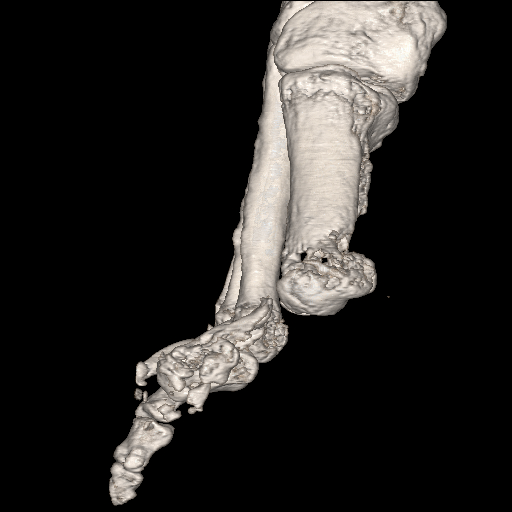 File:Advanced osteomyelitis due to open metatarsal fracture (Radiopaedia 83891-99095 VRT 7).jpg