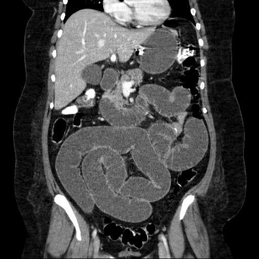 File:Afferent loop syndrome - secondary to incarcerated trocar site hernia (Radiopaedia 82959-97305 Coronal C+ portal venous phase 72).jpg