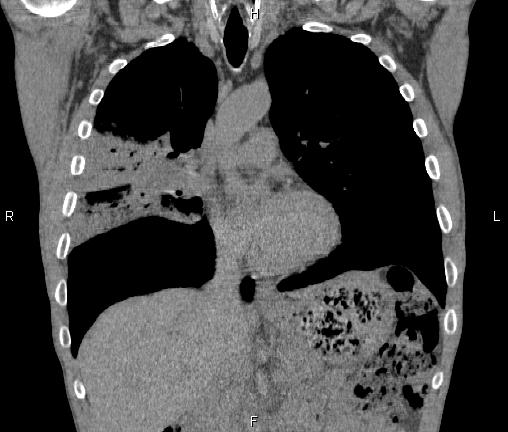 Air bronchogram in pneumonia (Radiopaedia 85719-101512 Coronal non-contrast 25).jpg