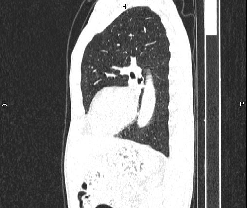 Air bronchogram in pneumonia (Radiopaedia 85719-101512 Sagittal lung window 65).jpg