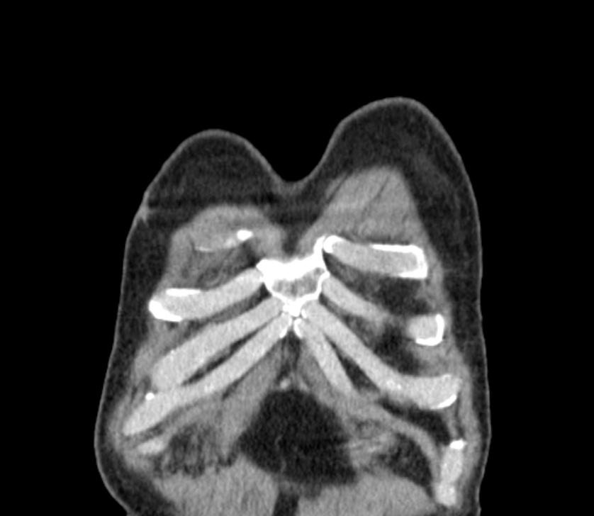 Airway foreign body in adult (Radiopaedia 85907-101779 Coronal liver window 4).jpg