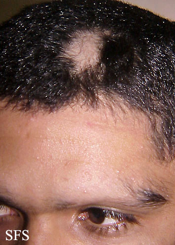Alopecia Areata (Dermatology Atlas 9).jpg