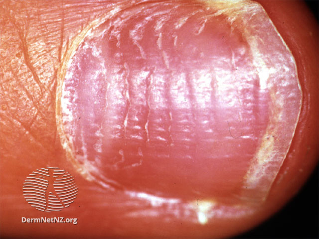 File:Alopecia areata (DermNet NZ hair-nails-sweat-pits-aa).jpg