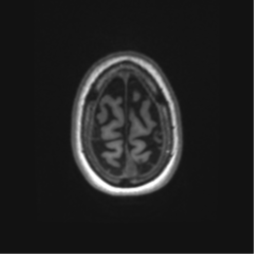 Alzheimer's disease (Radiopaedia 42658-45802 Axial T1 23).png