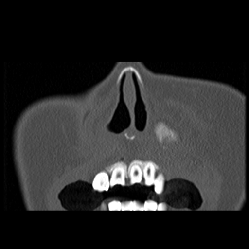 File:Ameloblastic fibro-odontoma (Radiopaedia 18843-18780 B 4).jpg