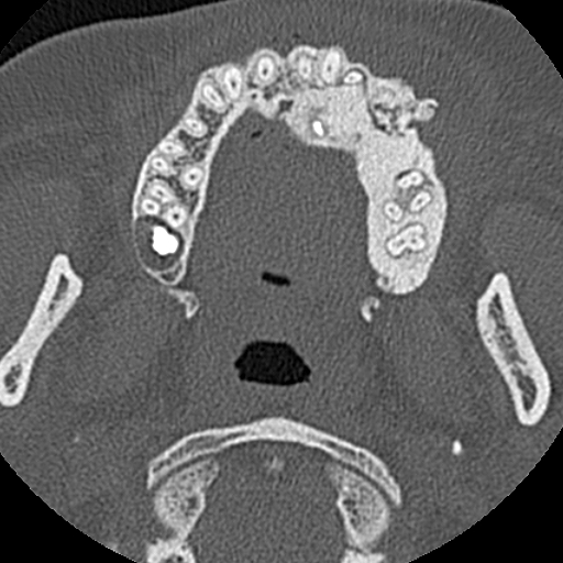 File:Ameloblastic fibro-odontoma (Radiopaedia 18843-18780 C 43).jpg