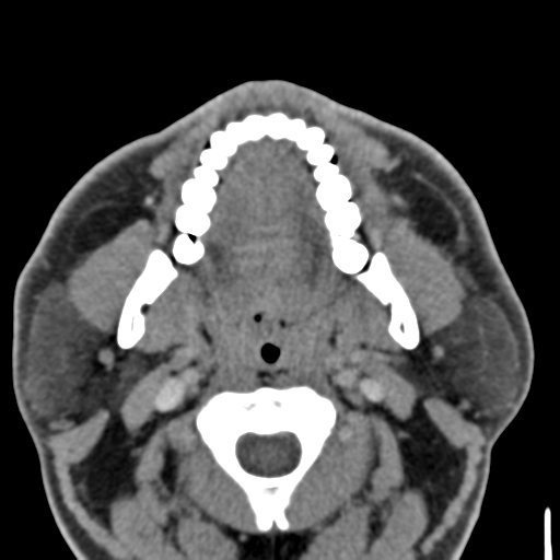 File:Ameloblastoma (Radiopaedia 33677-34806 Axial non-contrast 17).png