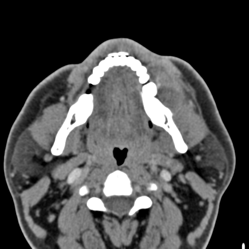 File:Ameloblastoma (Radiopaedia 33677-34806 Axial non-contrast 21).png