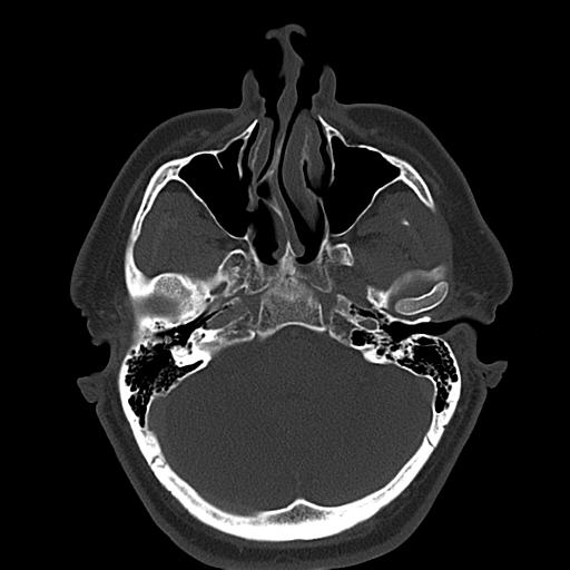 Ameloblastoma (Radiopaedia 38520-40623 Axial bone window 13).png