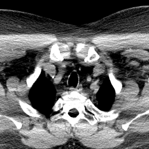 Ameloblastoma (Radiopaedia 38520-40623 Axial non-contrast 76).png