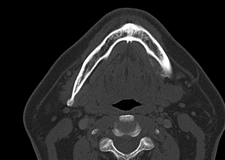 Ameloblastoma (Radiopaedia 38520-40623 D 36).png