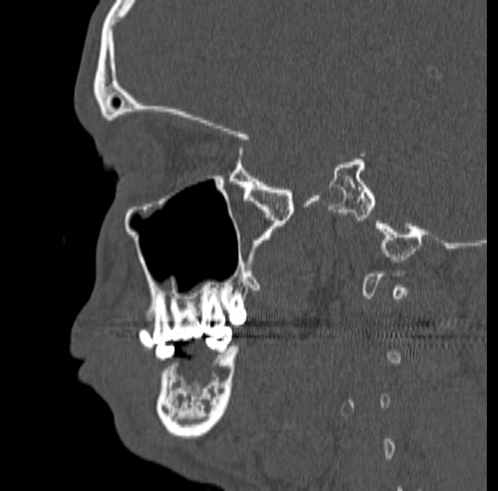Ameloblastoma (Radiopaedia 77750-89997 Sagittal bone window 38).jpg