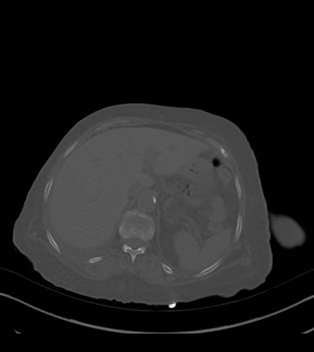 Amiodarone deposition in the liver (Radiopaedia 77587-89780 Axial bone window 78).jpg