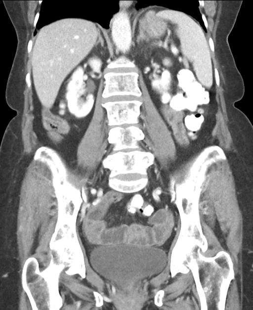 Ampullary adenocarcinoma (Radiopaedia 34013-35237 E 32).png