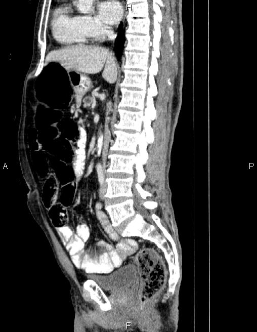 Ampullary adenocarcinoma (Radiopaedia 86093-102032 D 47).jpg