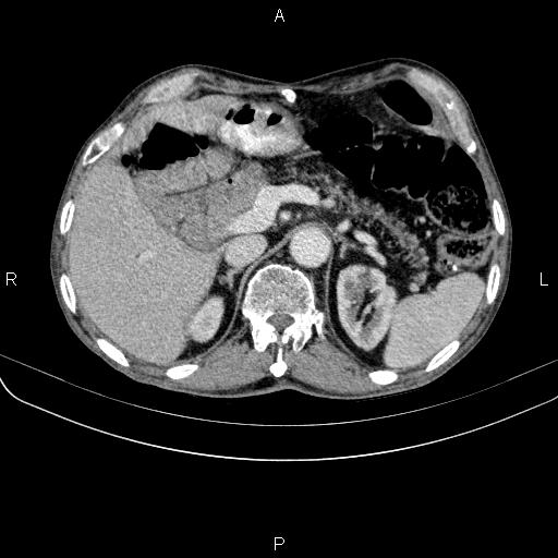 File:Ampullary adenocarcinoma (Radiopaedia 86093-102033 B 57).jpg
